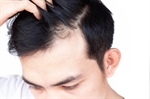 Restoring a Receding Hairline: FUE vs. FUT Hair Transplants