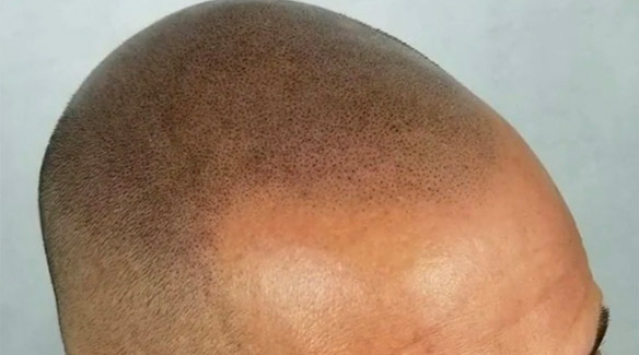 Hair Transplant